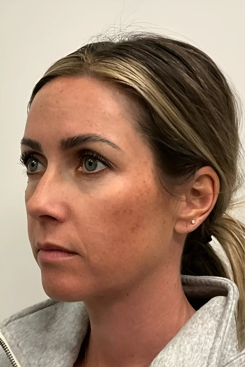 files/botox-cosmetic-1056-left-oblique-detail_1.webp
